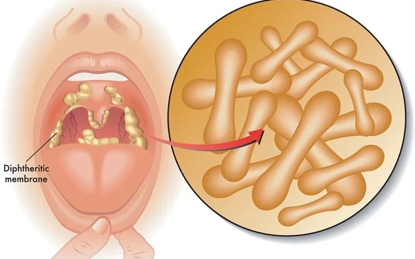 Diphtheria Outbreak: Ohonbamu Urges Parents to Vaccinate Children