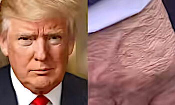 Trump Diagnosed with Vein Disorder – White House Confirms